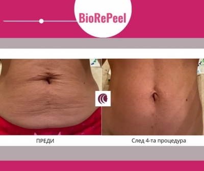      4   BioRePeel.