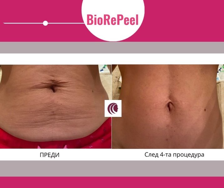      4   BioRePeel 