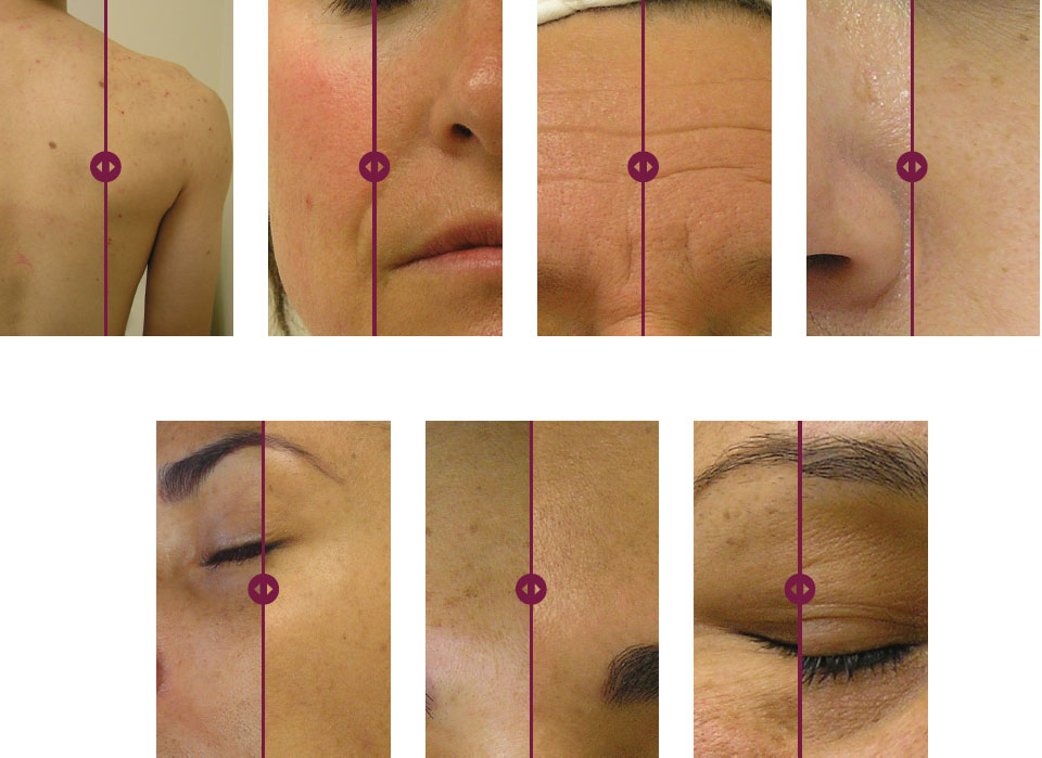 hydrafacial-page